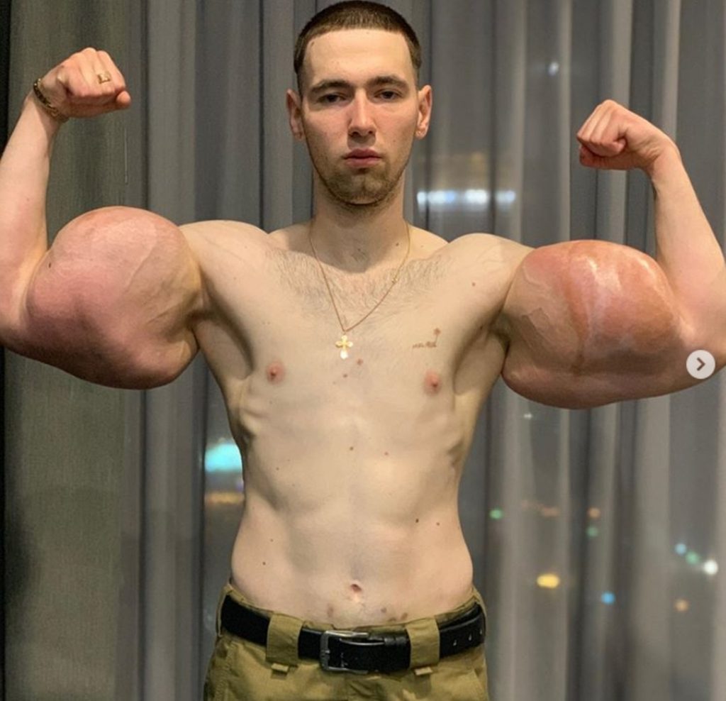 synthol young bodybuilder