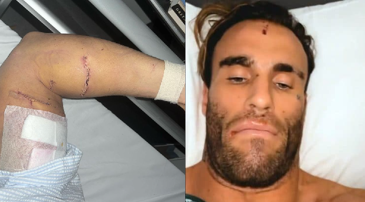 calum von moger injuries